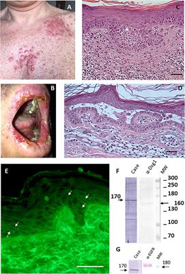 Case report: A rare case of imiquimod-induced atypical pemphigus vulgaris